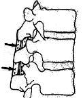 ligamento interspinoso