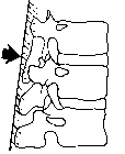 ligamento sopraspinoso